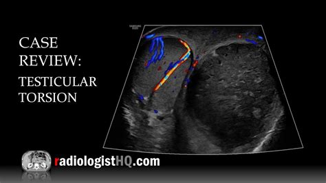 Case Review Ultrasound Of Testicular Torsion Youtube
