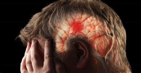 Causas síntomas y tratamiento para controlar una hemorragia cerebral