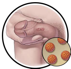 If i am sexually active already, can i still get the vaccine? How does a guy know if he has hpv - NISHIOHMIYA-GOLF.COM