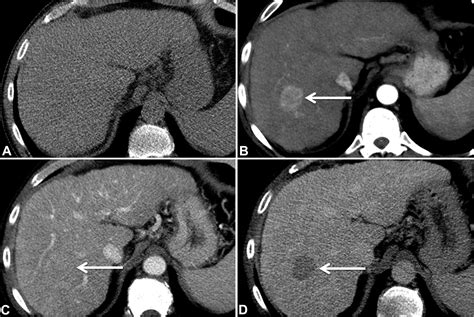 Hepatocellular Carcinoma Diagnosis Treatment Algorithms And Imaging