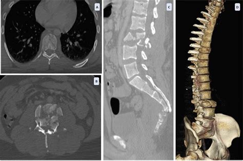 Preoperative Ct Scans A Axial View Of Stable Compression Fracture Of