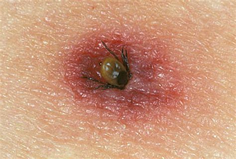 Tick Bite Pictures Symptoms Causes Treatment Hubpages