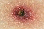 Tick bites on Humans – Images, Symptoms, Causes, Treatment - HubPages