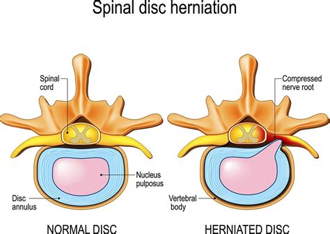 Cervical Disc Herniation Is A Common Cause Of Neck Upper Body Pain