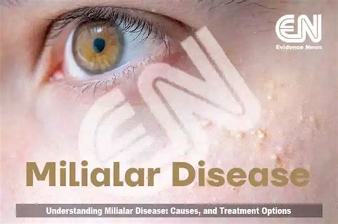 Understanding Milialar Disease Causes And Treatment Options