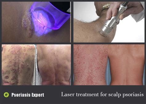Laser Treatment For Psoriasis Psoriasis Expert