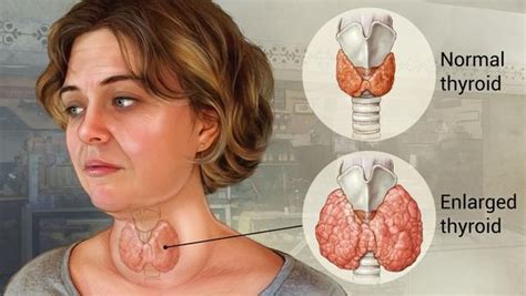 What Is A Goiter Quora
