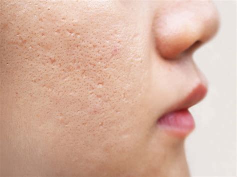 Skin Clinic In Pune Best Skin Specialist In Pune Clear Skin