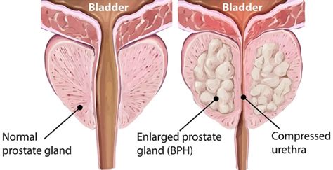 Benign Prostatic Hyperplasia Bph Nurses Revision