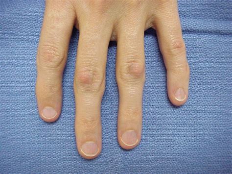 Arthritis Bumps On Fingers Check More At