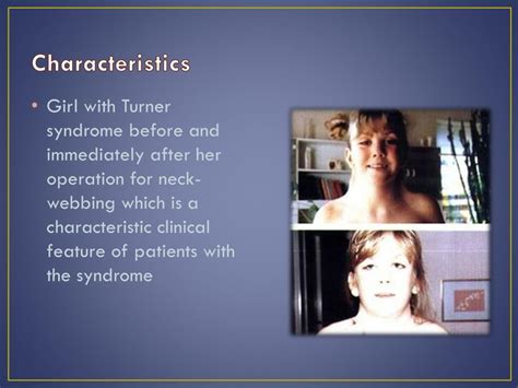 Ppt Turner Syndrome Powerpoint Presentation Free Download Id2600553