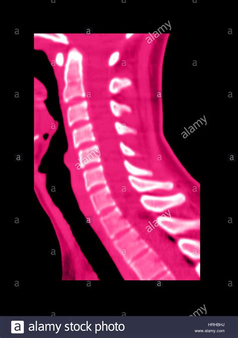 Normal Cervical Spine Stock Photo Alamy
