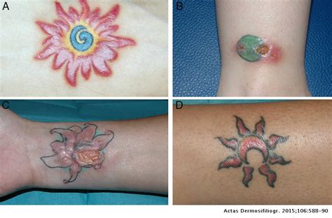 Top 108 Sarcoid Granuloma Tattoo