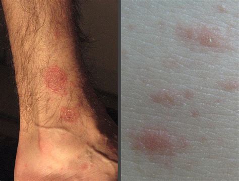 Pictures Of Skin Rashes Slideshow