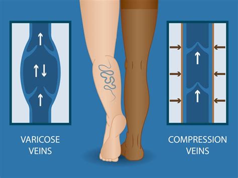 8 Ways To Get Rid Of Varicose Veins At Home