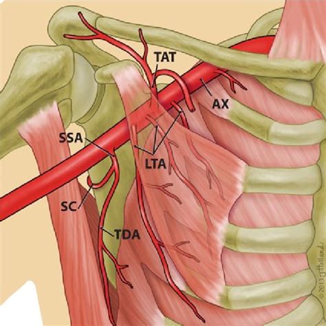 Type V Multiple Lateral Thoracic Arteries Lta Are Present
