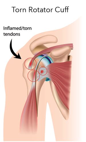 Shoulder bursitis and tendinitis are common causes of shoulder pain and stiffness. Practical Guide to Shoulder Pain | Sidekick Blog
