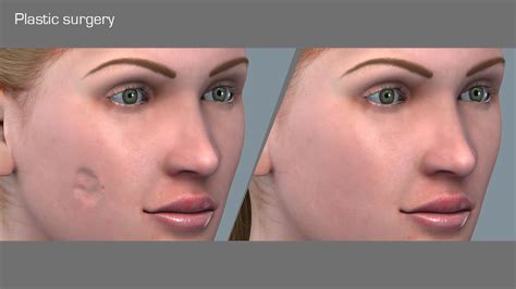 Cosmetic Plastic And Reconstructive Surgery Scientific Animations