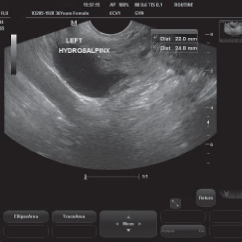 Transvaginal Ultrasound Scan Showing Left Hydrosalpinx Download