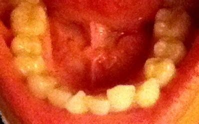 Some crooked teeth develop during childhood. Will Invisalign work for my very crowded and crooked ...
