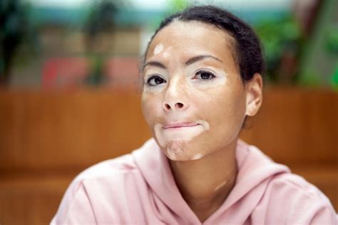 Premium Photo Black African American Woman With Vitiligo Pigmentation