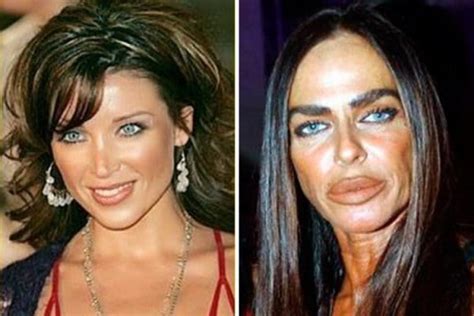 Plastic Surgery Gone Wrong With Before And After Pictures Wondersify