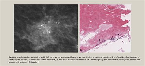 Benign Microcalcification And Its Differential Diagnosis In Breast