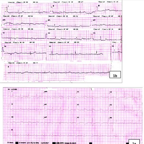A Ecg Showing Complete Heart Block With St Segment Elevation In