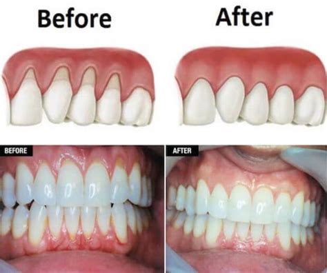 How To Grow Back Receding Gums With These Home Remedies