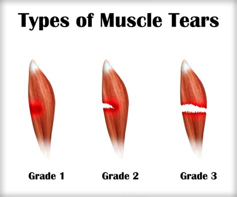 Muscle Strains Symptoms Causes And Treatment • Bodybuilding Wizard