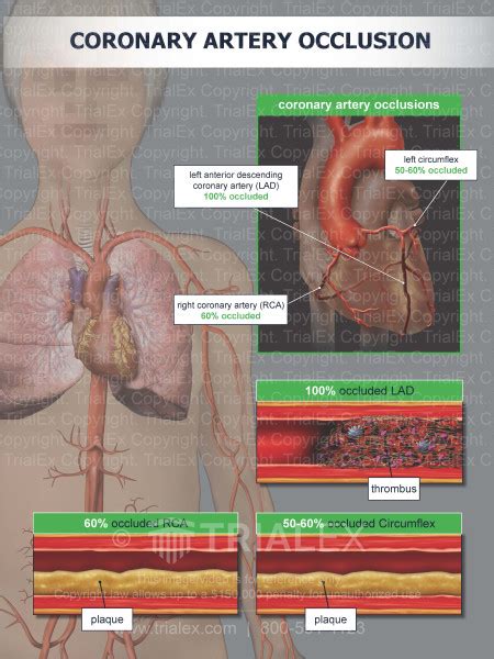 Coronary Artery Occlusion Trial Exhibits Inc