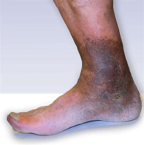 Venous Stasis Ulcer Foot