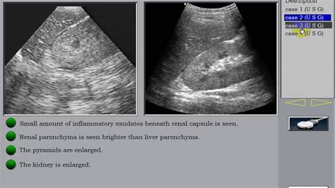 Ultrasound Of The Kidney 3 Inflammatory Kidney Disesaes Pyelonephritis