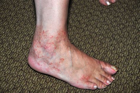 Red Rashes On Ankles Pictures Photos