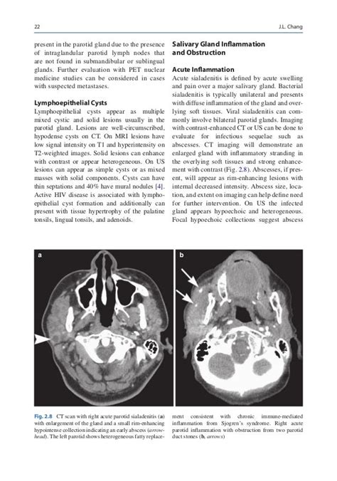 Gland Preserving Salivary Surgery