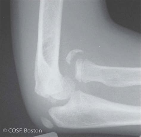 Monteggia Fracture Dislocations Musculoskeletal Key