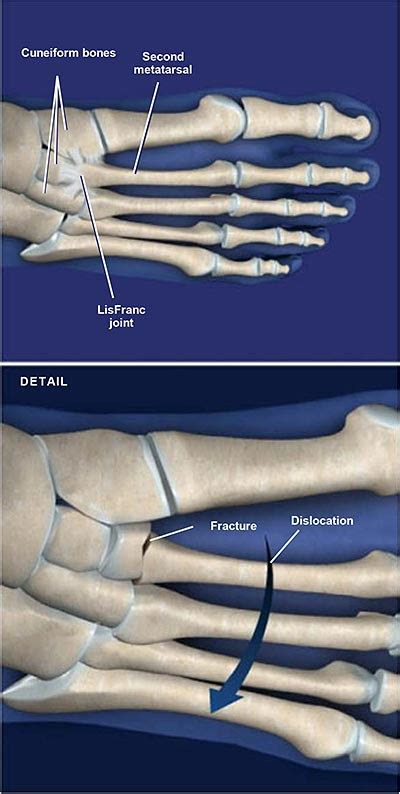 Lisfranc Midfoot Fracture Dislocation Central Coast Orthopedic