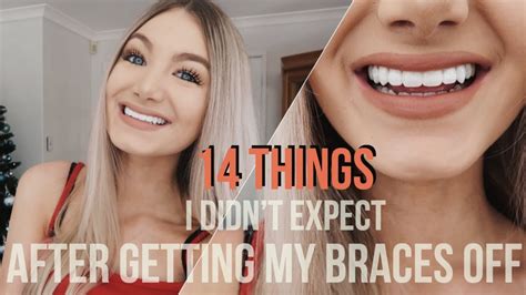 Getting Your Braces Off What To Expect Share Idea