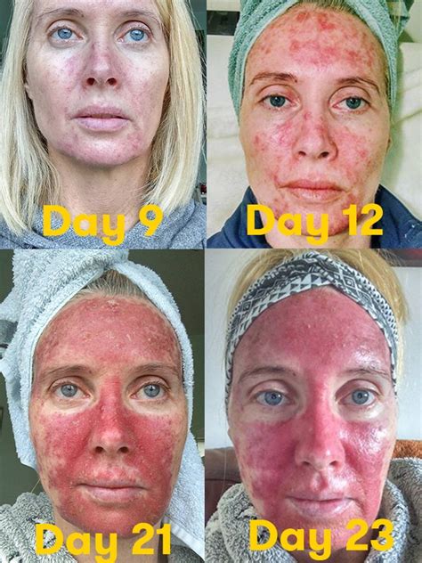 Topical Chemotherapy Skin Cancer Dermaclear