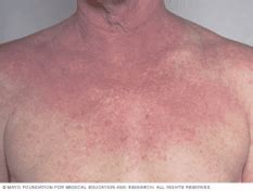 Dermatita Atopica Osteodensys