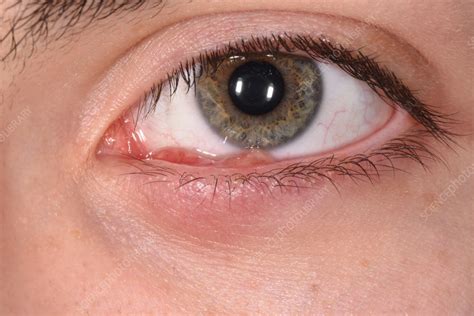 Granulation Tissue On The Lower Eyelid Stock Image C0564691
