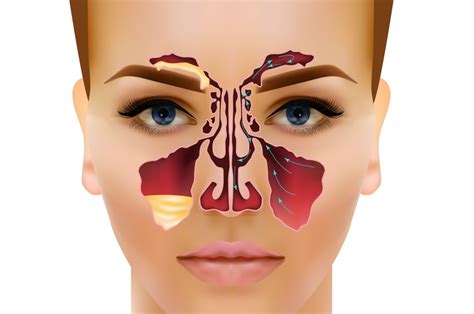 Sinusitis What It Is And Why Its So Hard To Cure Oicanadian