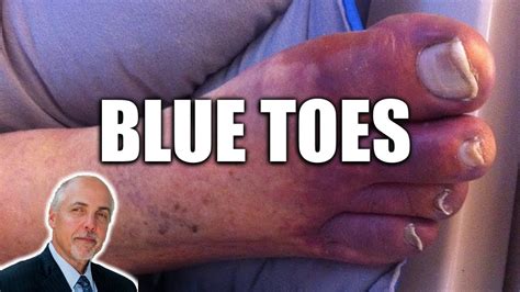 Blue Toes A Clinical Approach Youtube