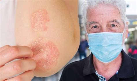 Coronavirus Uk Covid Symptoms And Signs Of Infection Include Heat Rash