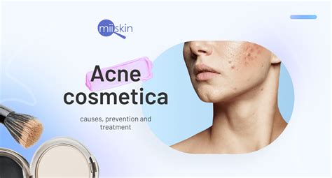 Acne Causes Treatment And Care Tips For Acne Prone Skin