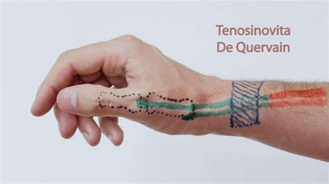 De Quervains Tenosynovitis Mississauga Chiropractor And