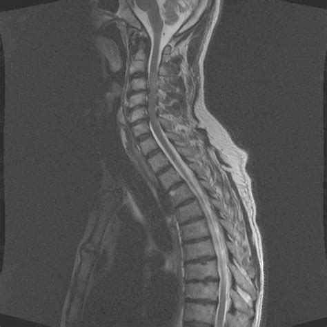 Sagittal T2 Weighted Magnetic Resonance Imaging Of The Cervical Spine