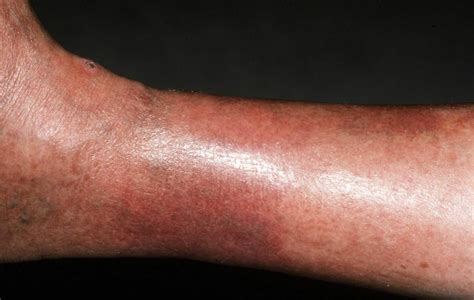 Stasis Dermatitiseczema On Legs Symptoms Causes Treat Vrogue Co