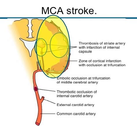 Middle Cerebral Artery Stroke New Health Advisor