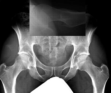 The Femoral Headneck Offset And Hip Resurfacing Bone And Joint